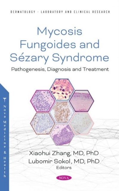 Mycosis Fungoides and Sezary Syndrome - Pathogenesis, Diagnosis and Treatment