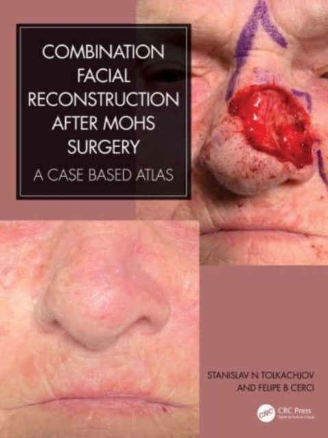 Combination Facial Reconstruction After Mohs Surgery - A Case Based Atlas