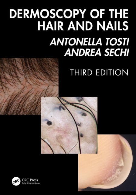 Dermoscopy of the Hair and Nails