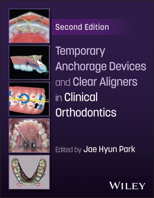 Temporary Anchorage Devices and Clear Aligners in Clinical Orthodontics