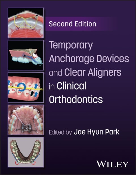 Temporary Anchorage Devices and Clear Aligners in Clinical Orthodontics