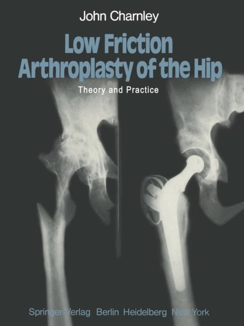 Low Friction Arthroplasty of the Hip - Theory and Practice