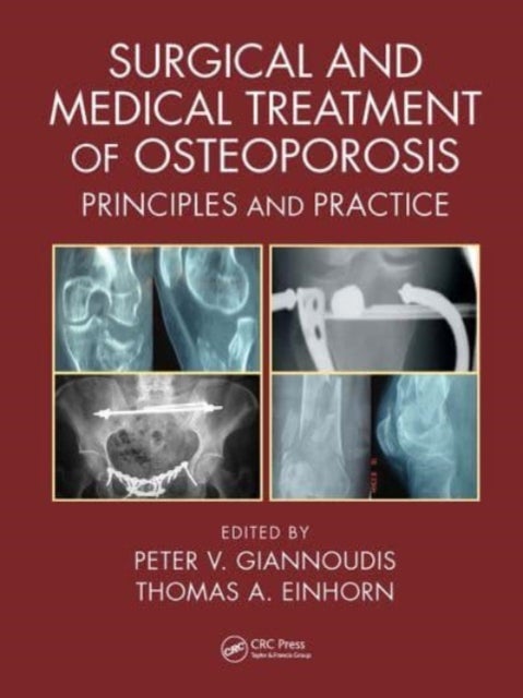 Surgical and Medical Treatment of Osteoporosis - Principles and Practice