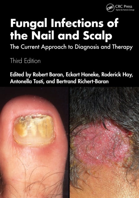 Fungal Infections of the Nail and Scalp - The Current Approach to Diagnosis and Therapy