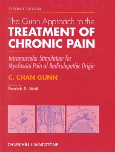 The Gunn Approach to the Treatment of Chronic Pain - Intramuscular Stimulation for Myofascial Pain of Radiculopathic Origin