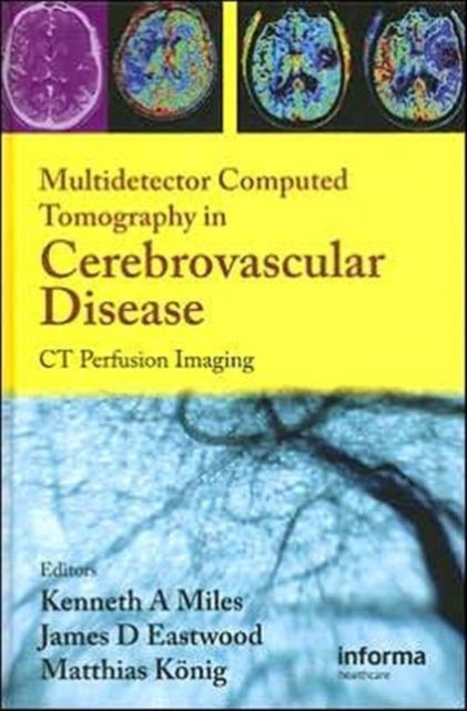 Multidetector Computed Tomography in Cerebrovascular Disease - CT Perfusion Imaging