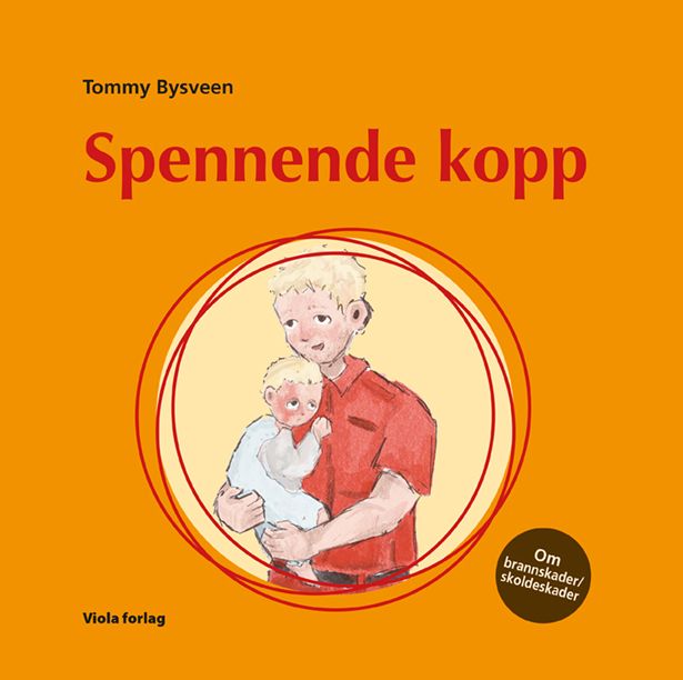 Spennende kopp - om brannskader/skoldeskader