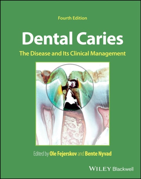 Dental Caries - The Disease and its Clinical Management