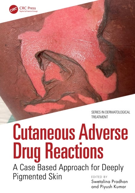 Cutaneous Adverse Drug Reactions - A Case Based Approach for Deeply Pigmented Skin