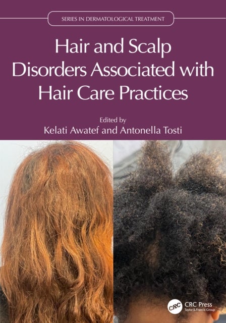 Hair and Scalp Disorders Associated with Hair Care Practices