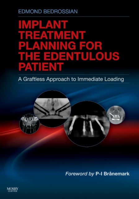 Implant Treatment Planning for the Edentulous Patient - A Graftless Approach to Immediate Loading