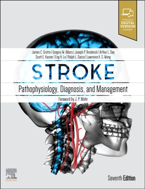 Stroke - Pathophysiology, Diagnosis, and Management