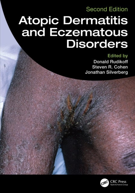 Atopic Dermatitis and Eczematous Disorders