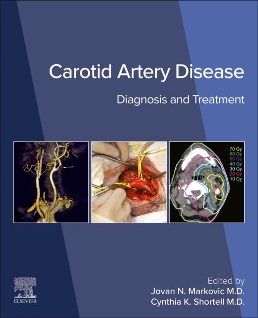 Carotid Artery Disease - Diagnosis and Treatment