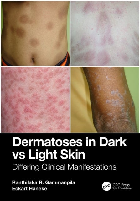 Dermatoses in Dark Vs Light Skin - Differing Clinical Manifestations
