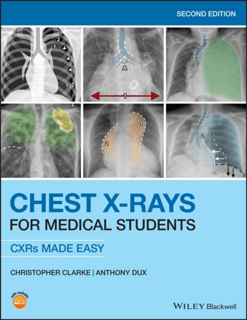Chest X-Rays for Medical Students - CXRs Made Easy