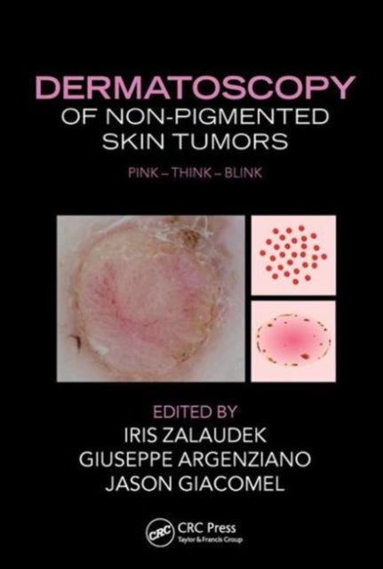 Dermatoscopy of Non-Pigmented Skin Tumors - Pink - Think - Blink