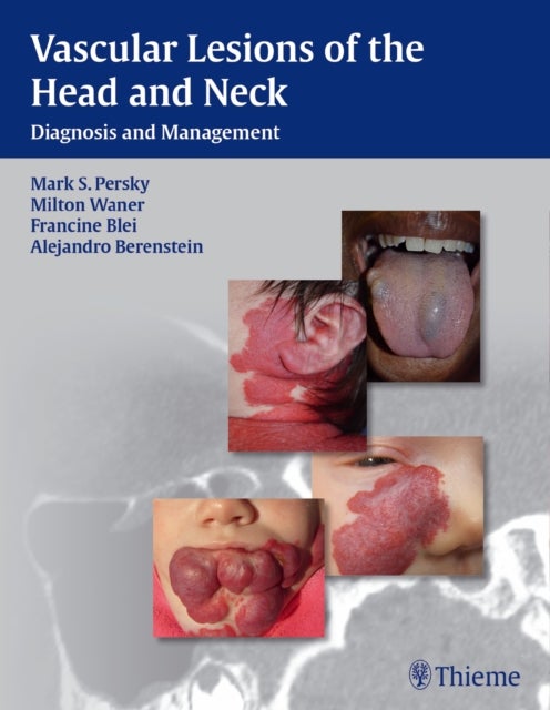 Vascular Lesions of the Head and Neck - Diagnosis and Management