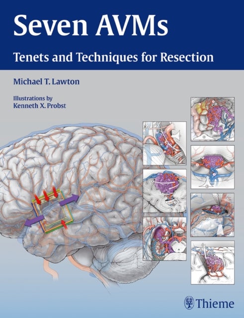 Seven AVMs - Tenets and Techniques for Resection