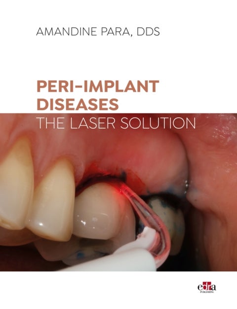 Peri-implant Diseases: The Laser Solution