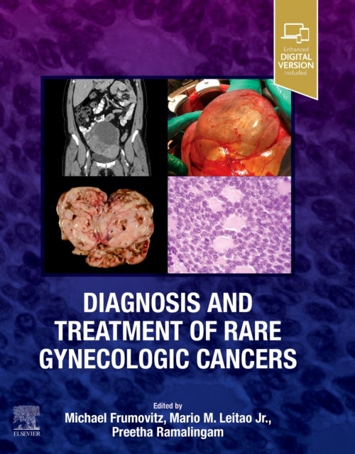 Bilde av Diagnosis And Treatment Of Rare Gynecologic Cancers Av Michael (professor Gynecologic Oncology Md Anderson Cancer Center) Frumovitz, Mario M. Md (memb