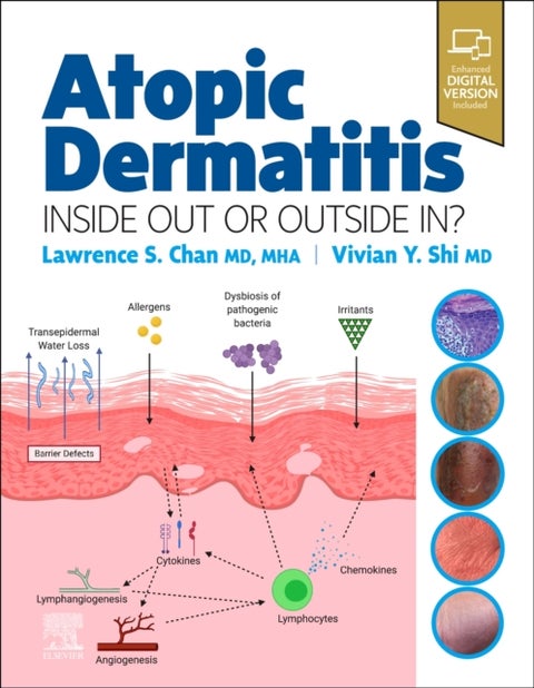 Atopic Dermatitis: Inside Out or Outside In