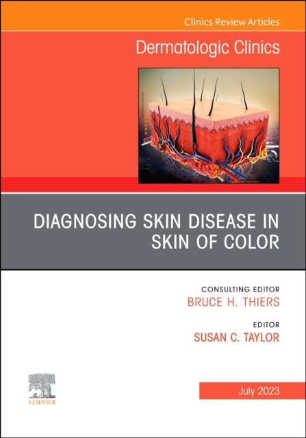 Bilde av Diagnosing Skin Disease In Skin Of Color, An Issue Of Dermatologic Clinics