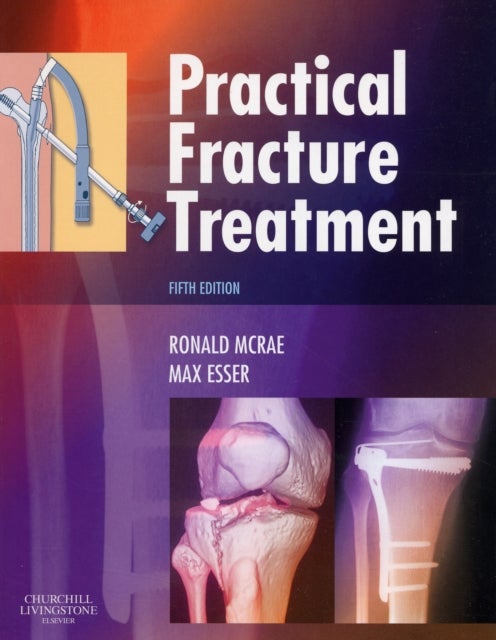 Bilde av Practical Fracture Treatment Av Ronald (formerly Consultant Orthopaedic Surgeon Southern General Hospital Glasgow Uk) Mcrae, Max (orthopaedic Surgeon