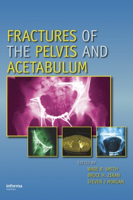 Bilde av Fractures Of The Pelvis And Acetabulum