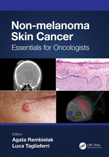 Non-melanoma Skin Cancer - Essentials for Oncologists