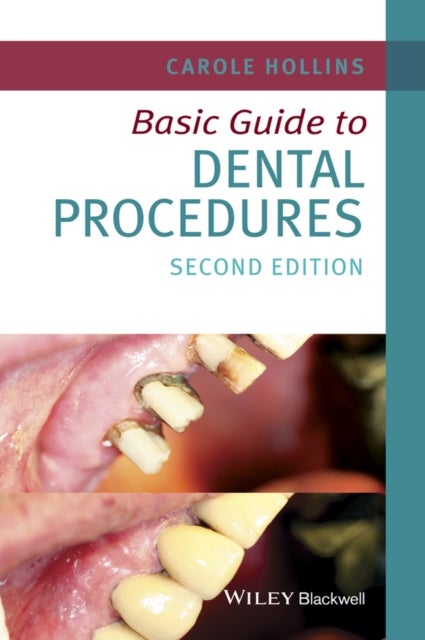 Bilde av Basic Guide To Dental Procedures Av Carole (dental Practitioner Uk) Hollins