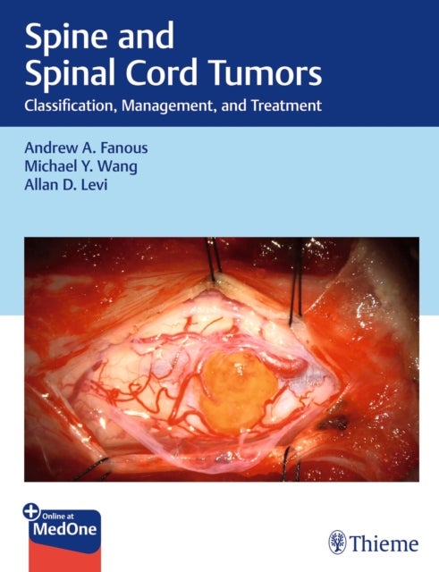 Spine and Spinal Cord Tumors - Classification, Management, and Treatment
