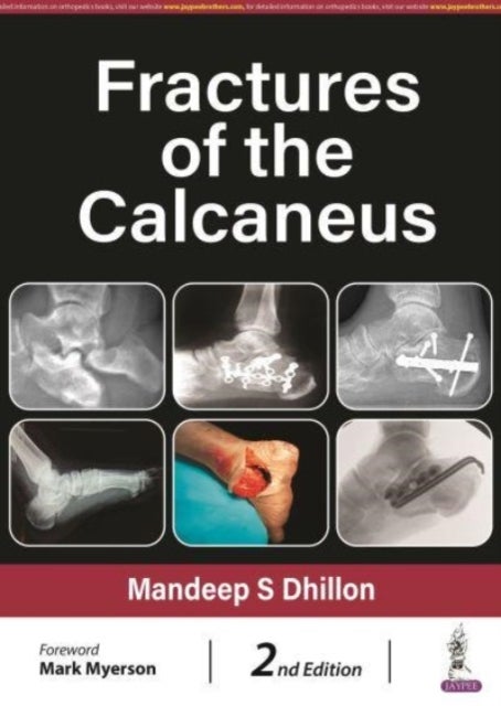 Bilde av Fractures Of The Calcaneus Av Mandeep S Dhillon